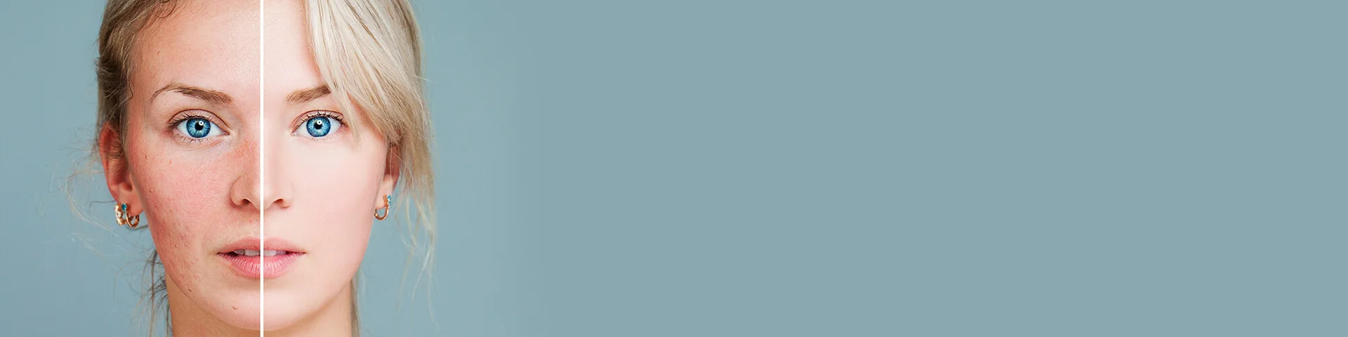 Hormones<br> Dealing with hormonal acne<br>how to recognise and treat it